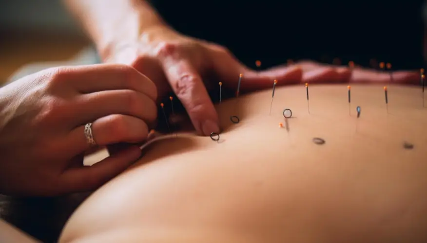 acupuncture-treatment-close-up.jpg