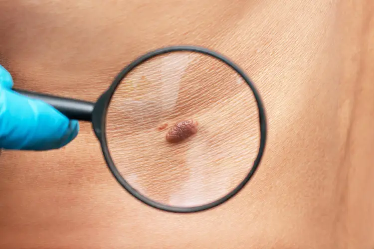 close-up-mole-skin-exam.jpg