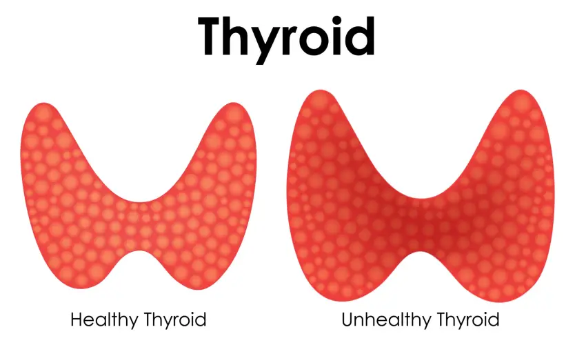 thyroid-comparison-healthy-vs-unhealthy.jpg