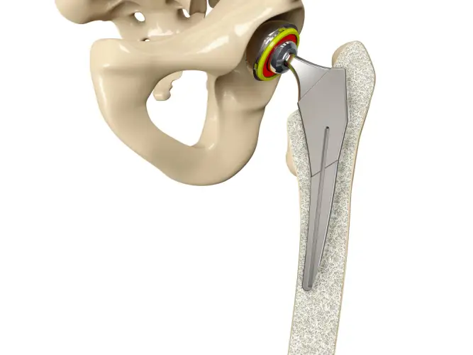 hip-replacement-implant-3d-illustration.jpg